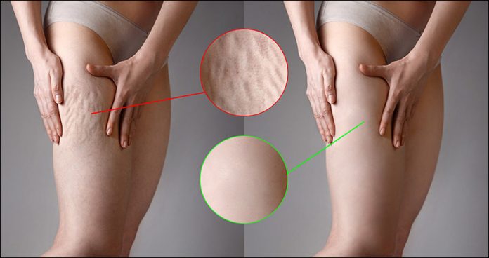 How to get rid of cellulite?