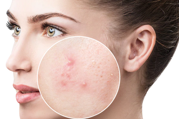 How to get rid of dark spots on face?