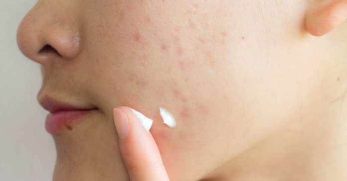 How to get rid of Acne Scars?